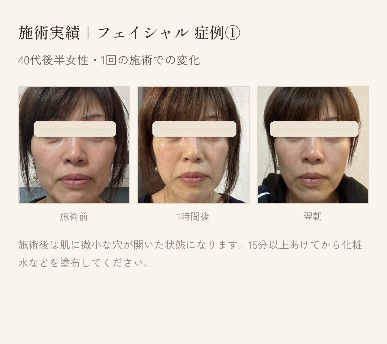 40代後半女性のフェイシャル施術実績 1回施術